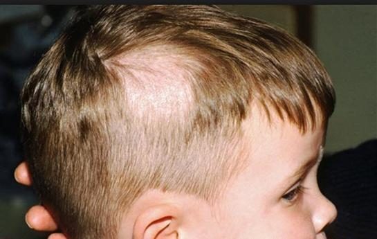 İlginç Bir Bozukluk: Trikotilomani